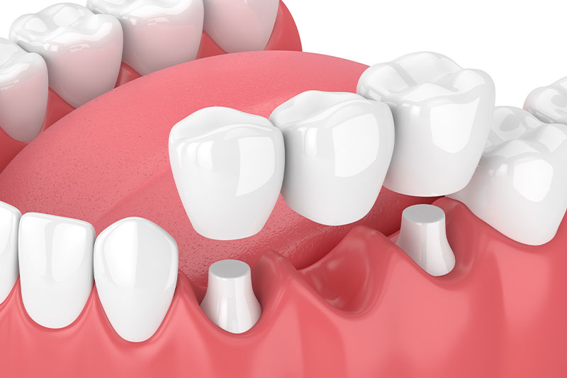 Dental Bridges in Edinburg