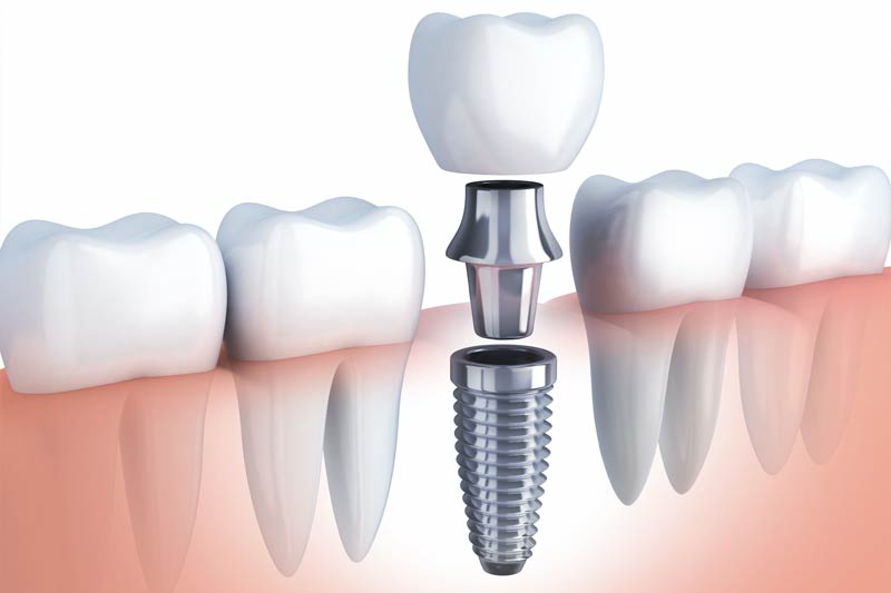 Implants Dentist in Edinburg