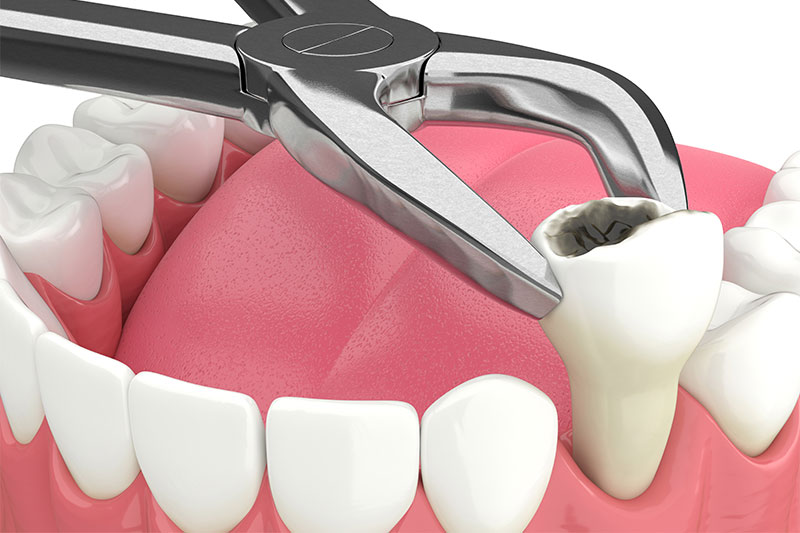 Tooth Extractions in Edinburg